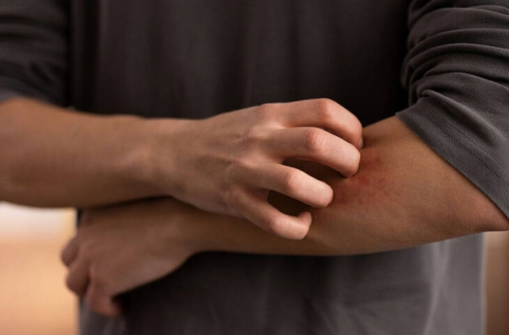 Eczema