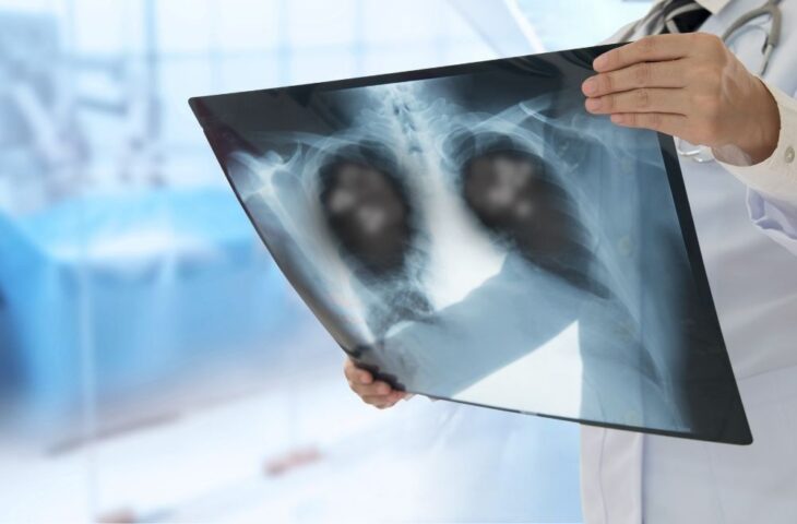 Pneumonia