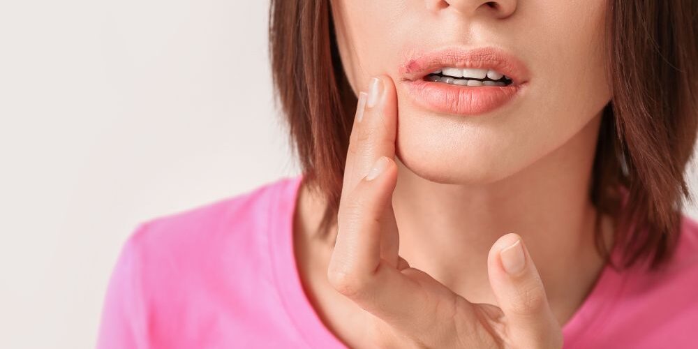 Herpes Labial Herpes Labial