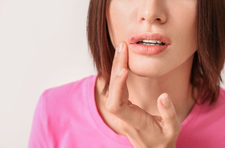 Herpes Labial