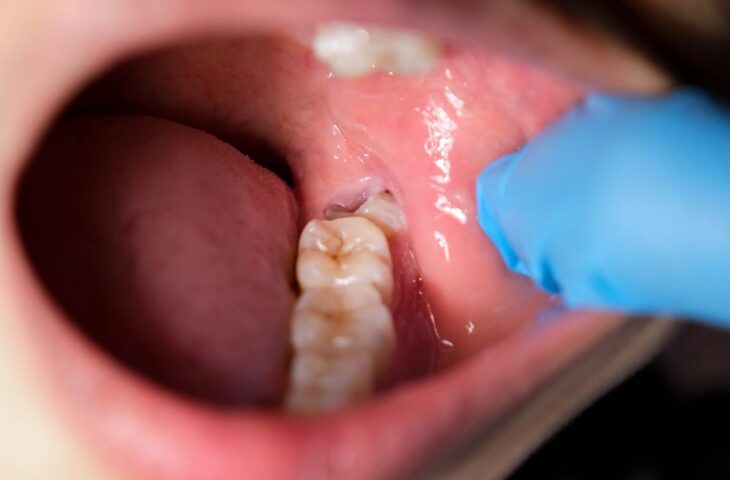dentes do siso