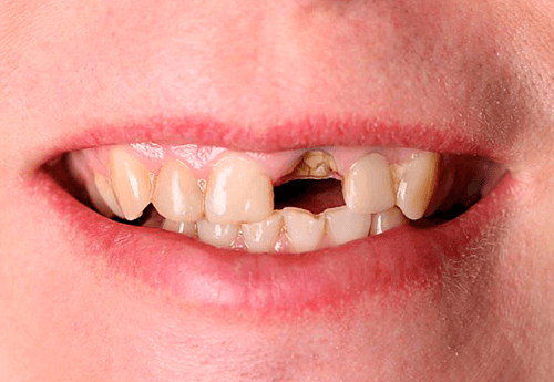 implante dentário agilcare