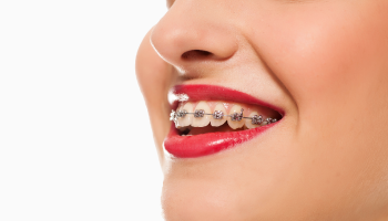 aparelho dentario autoligavel agilcare
