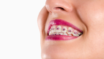 aparelho dentario convencional agilcare