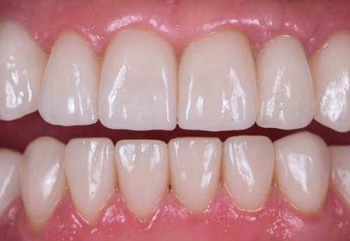 prótese dentária agilcare