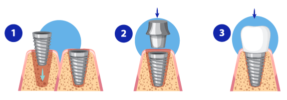 Implantes Dentários