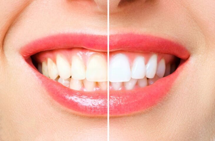 Branqueamento dentário