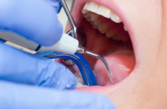 tártaro nos dentes