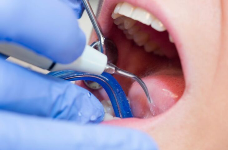 tártaro nos dentes