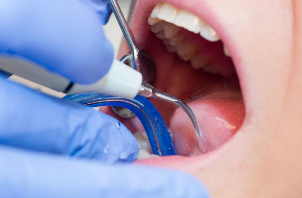 tártaro nos dentes