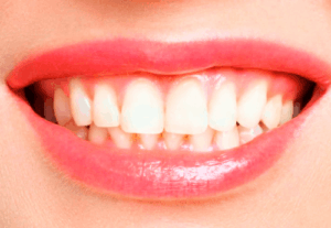branqueamento dentário agilcare