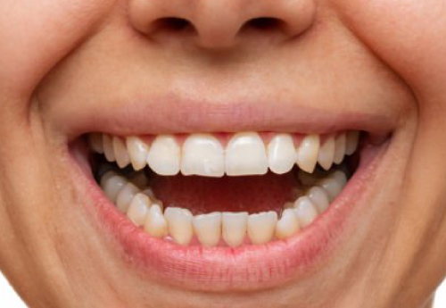 Facetas dentarias agilcare