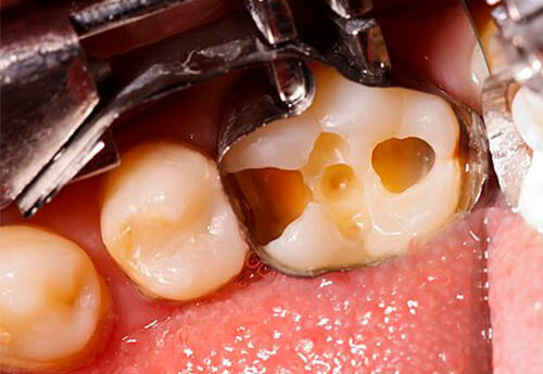 restauração dente agilcare