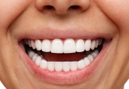 Facetas dentarias agilcare