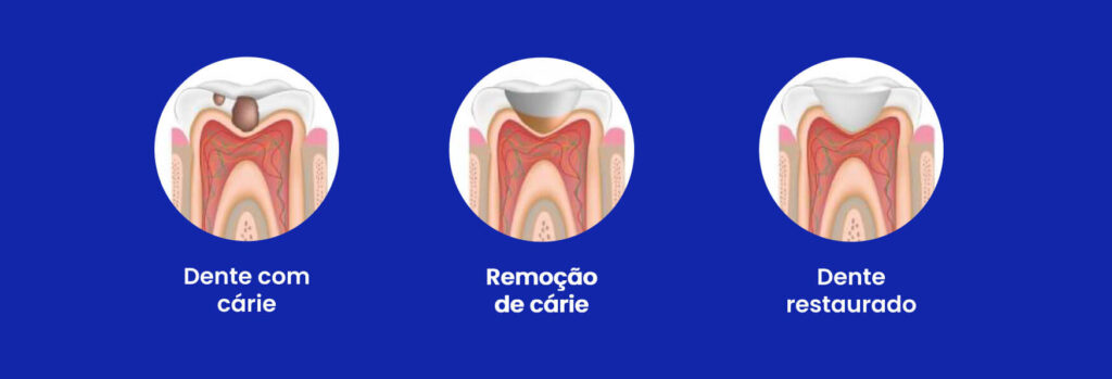 restauracao dente agilcare