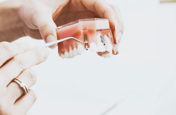 implante dentario plano dental agilcare