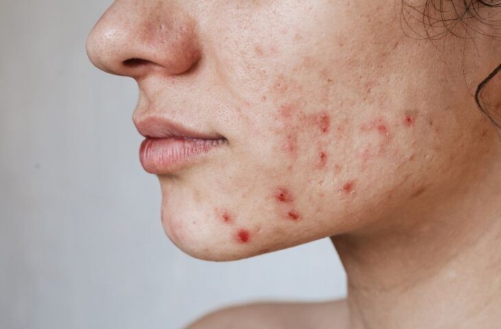 Acne