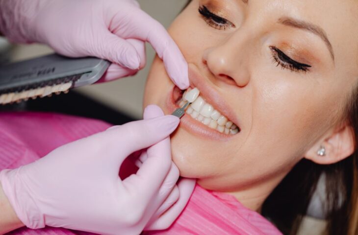 Facetas Dentárias