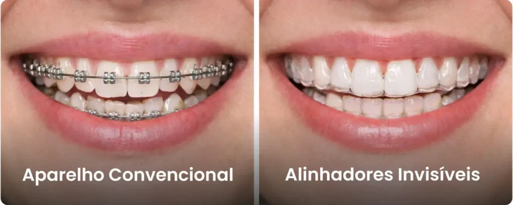 Alinhadores Invisíveis