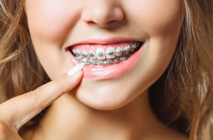 Aparelho Dentário: qual a melhor idade para o colocar?