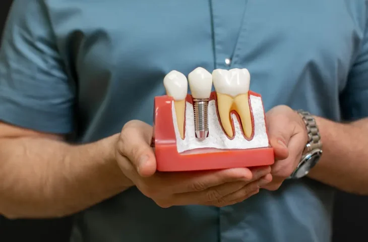 Implantes Dentários: que tipos existem?